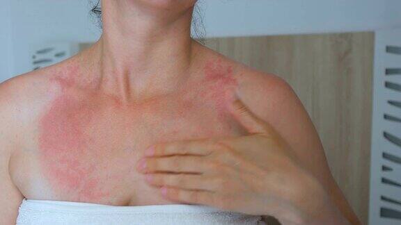 女人用手抓痒颈脖子上有红斑过敏牛皮癣虫咬疟疾晒伤晒伤