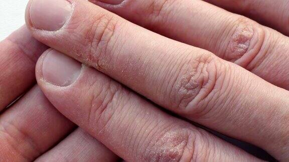 手指干燥皲裂有皮肤问题的手