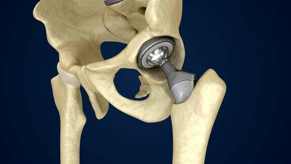 髋关节置换植入物安装在骨盆骨医学3D动画