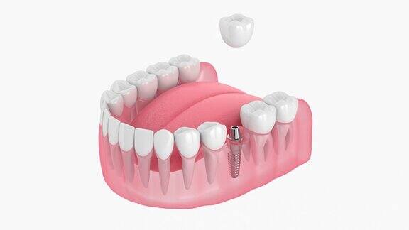 牙科植体位置