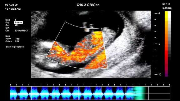 胎儿超声扫描