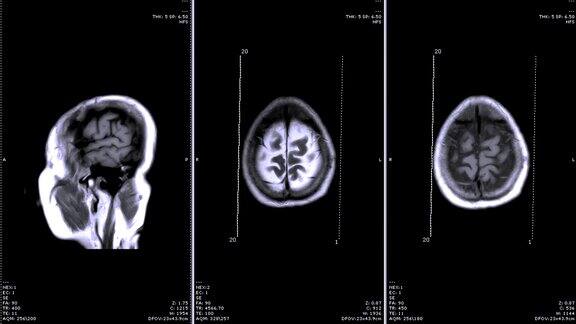 MRI对脑矢状面和冠状面比较