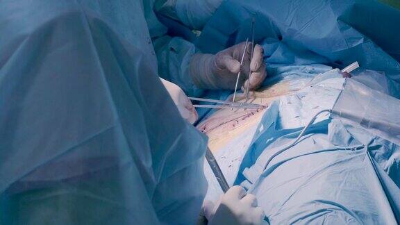 腹部手术腹部的外科手术缝合