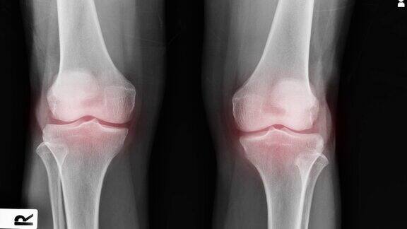 OA膝关节x线图像