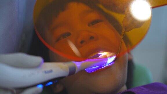 牙科医生之手正在牙科诊所为一名6岁的亚洲小孩做牙齿修复工作牙科医生使用紫外线灯在男孩的牙齿上