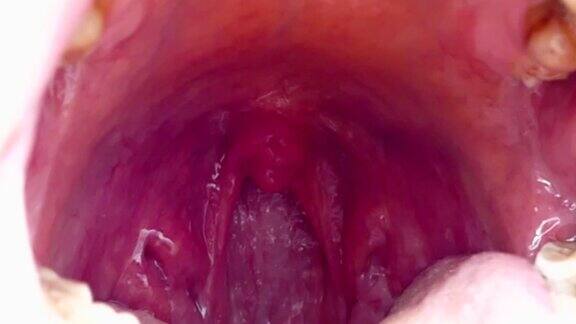 口腔内扁桃体扁桃体炎被人忽视的口腔