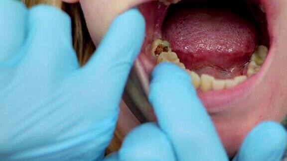 深龋开凿运河清理运河患者在口腔上入院牙周炎治疗