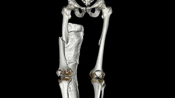 骨折股骨的CAT扫描