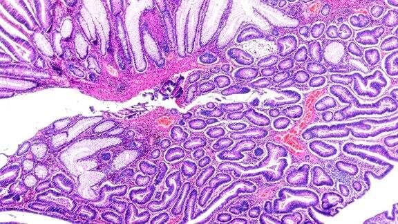 大肠癌(差异很大管状腺癌)在显微镜下不同部位放大
