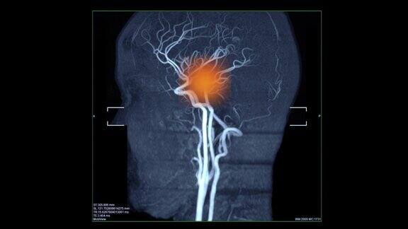 血管扫描显示中风