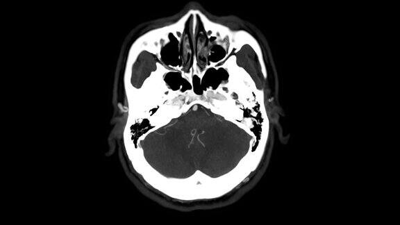 CTA脑部扫描或计算机断层血管造影的脑部轴位图