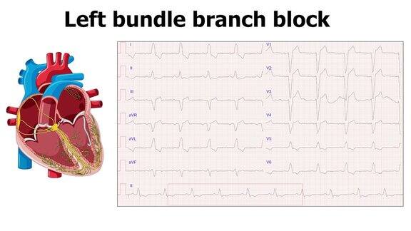 心电图显示左束支传导阻滞(LBBB)并伴有心脏动画