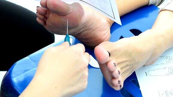 用针法检测足部敏感性的药物检测糖尿病足
