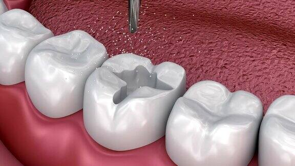龋齿去除牙裂填补医学上准确的3D插图