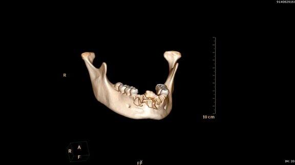 下颌骨三维渲染图像