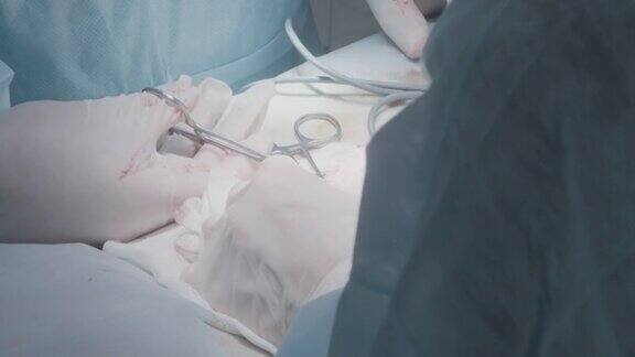 医生做手术切除阑尾行动外科医生在麻醉下给病人动手术肿瘤切除和器官手术